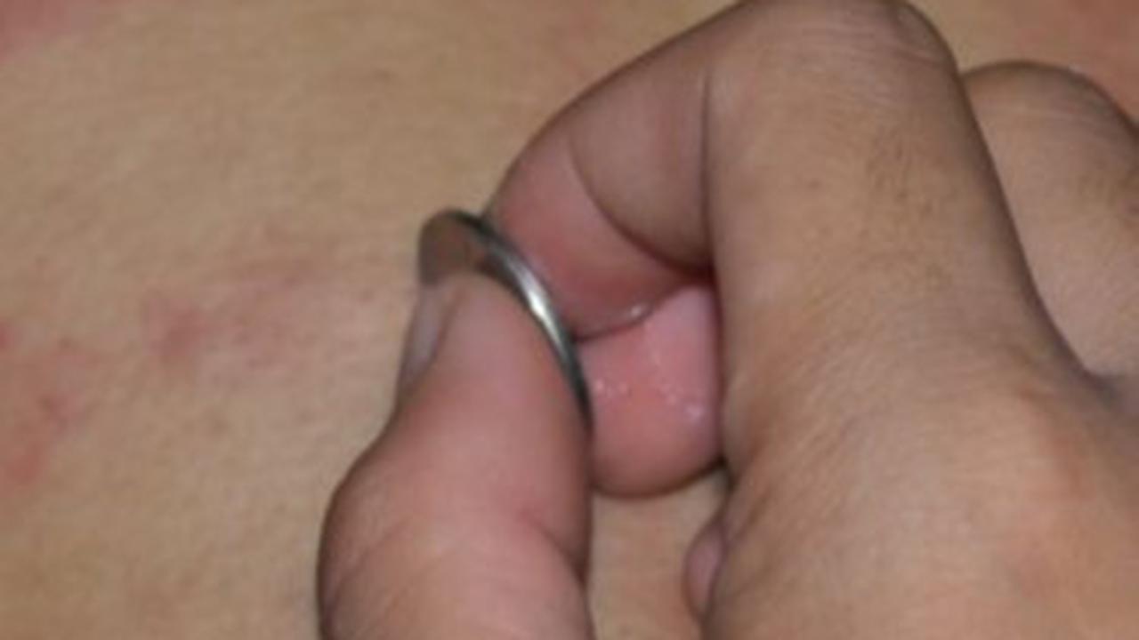 Dokter Ungkap Efek Bahaya Kerokan Pada Anak yang Kena Demam Berdarah