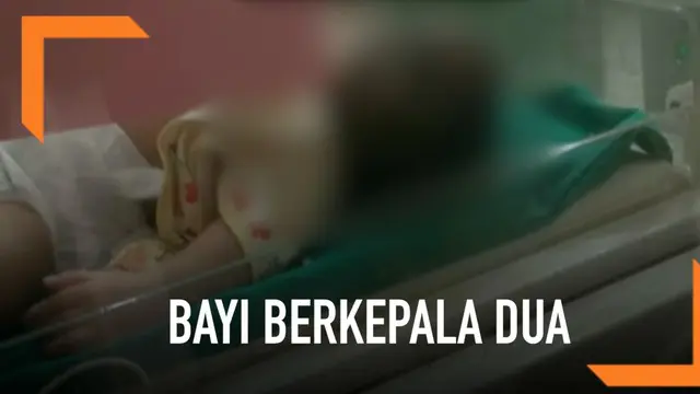 VIDEO: Bayi Berkepala Dua di Brebes Akhirnya Meninggal