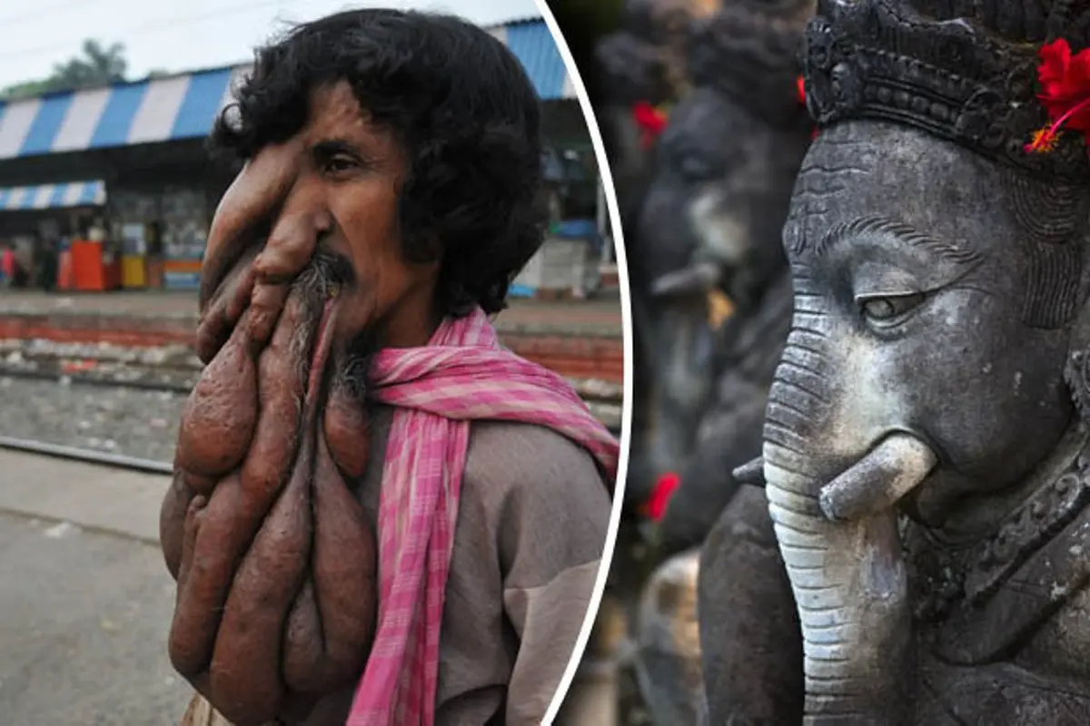 Miliki Belalai Seperti Gajah, Pengemis Ini Dianggap Dewa