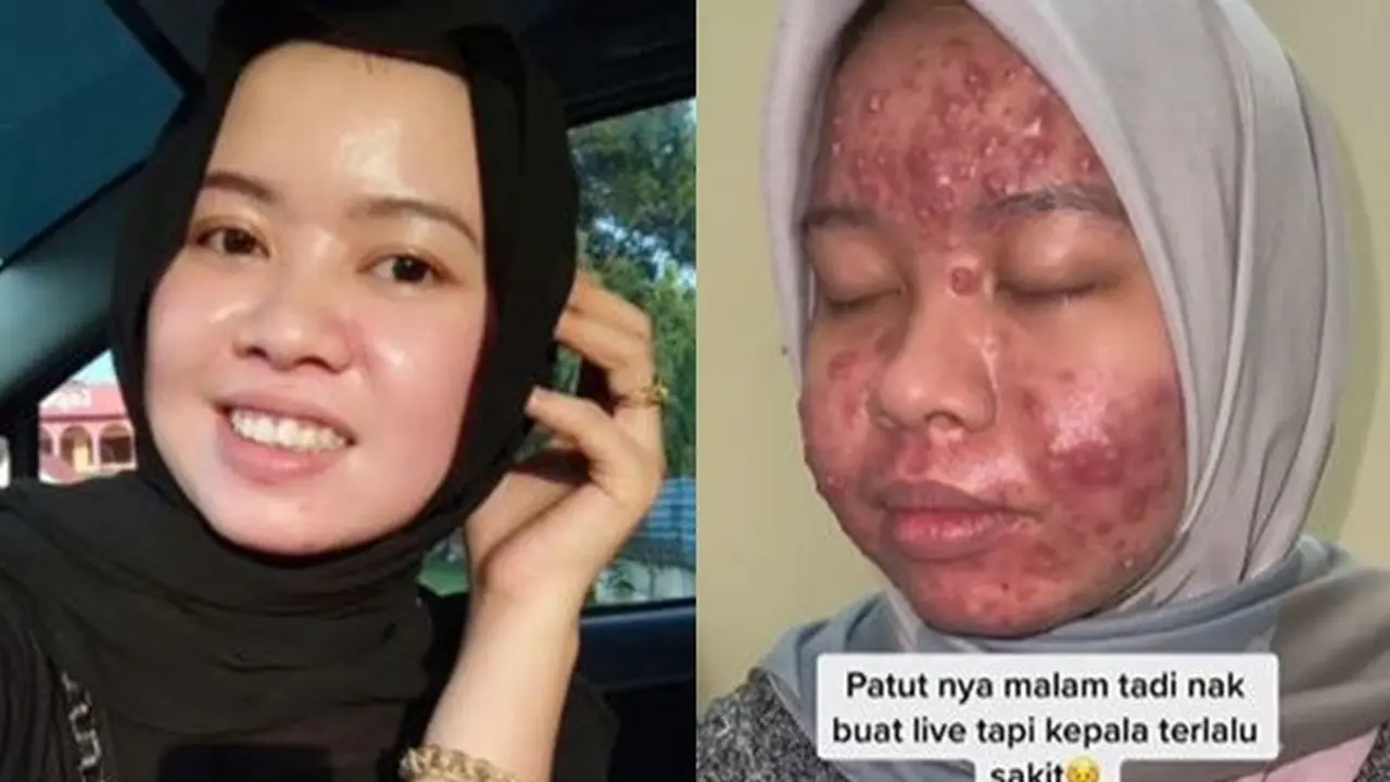 Sempat Disangka Terkena Guna-Guna, Wajah Wanita Ini Berubah Jerawatan Parah
