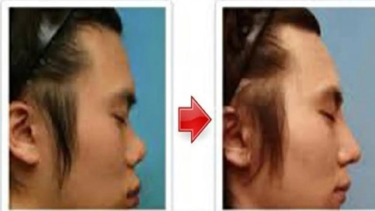Tanpa Operasi, Ini 6 Cara Alami Bikin Hidung jadi Mancung