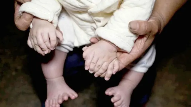 Bayi yang Lahir dengan 31 Jari Akhirnya Jalani Operasi