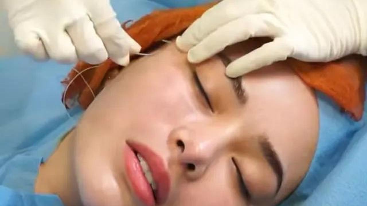 Meskipun prosedur tarik benang terdengar menakutkan, Amanda Manopo memastikan bahwa proses ini tidak sesakit yang dibayangkan.