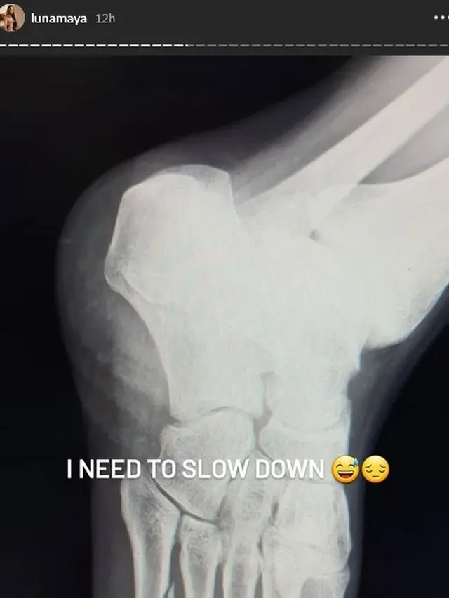 Alami Patah Tulang Metatarsal, Ini 6 Potret Kondisi Terbaru Luna Maya