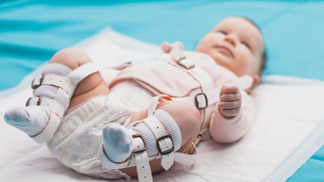 Hip Dysplasia, Gangguan Panggul yang Bisa Hambat Pertumbuhan Bayi