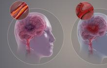 Jangan Panik Saat Stroke Terjadi: Langkah-Langkah Pertolongan Pertama yang Wajib Diketahui