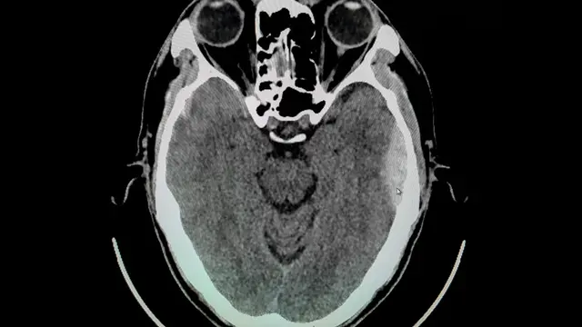 Epidural Hematoma - KlikDokter.com (Monet_3k/Shutterstock)
