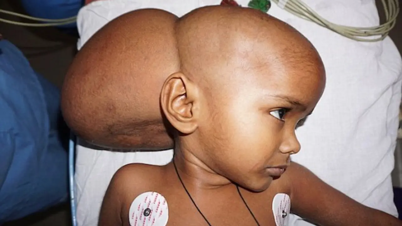 Tumor Seberat 30 Kg Berhasil Diangkat Dari Kepala Bocah Ini