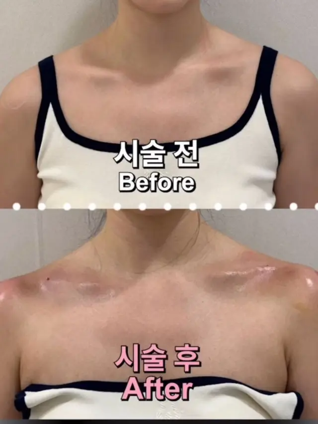 Filler Bahu Jadi Tren Baru di Korea Selatan, Harga Mulai Rp10 Jutaan untuk Bahu “Ideal” ala Jennie BLACKPINK?