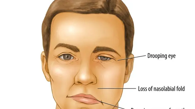 [Bintang] Bell Palsy