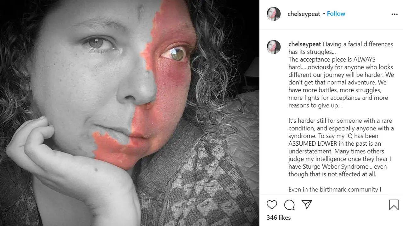 Chelsey Peat, 34, lahir dengan kondisi langka yang disebut Sturge-Weber Syndrome