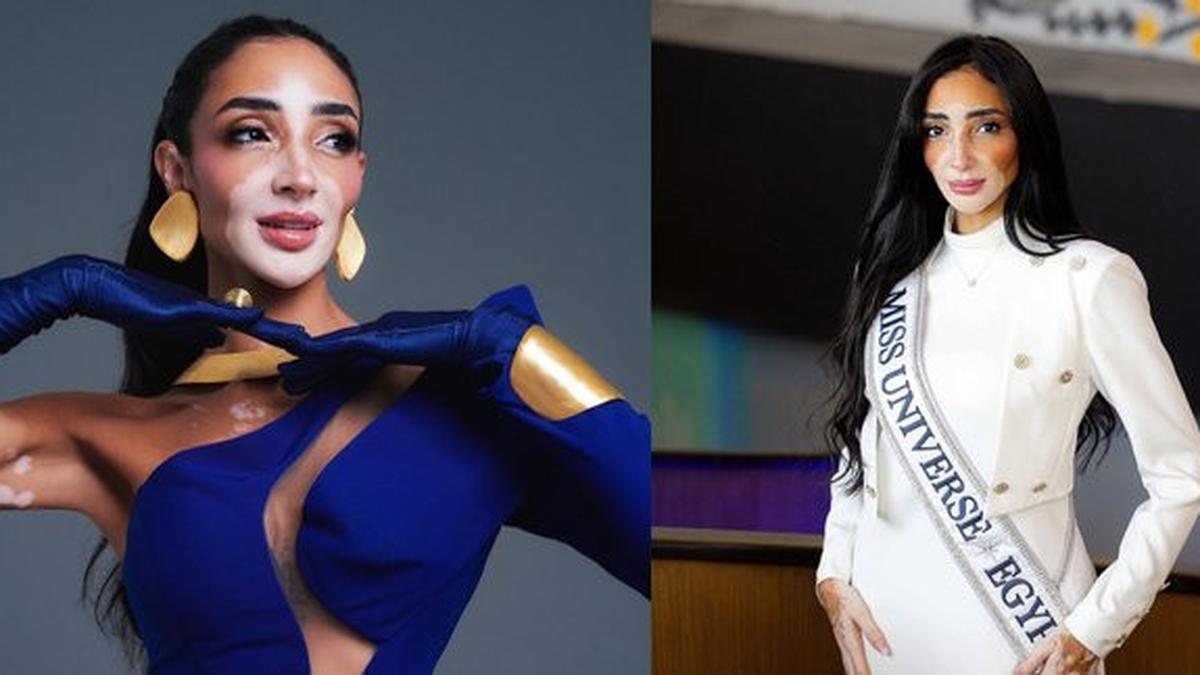 Buktikan Vitiligo Bukan Penghalang, Begini Sosok Logina Salah Miss Universe Mesir 2024
