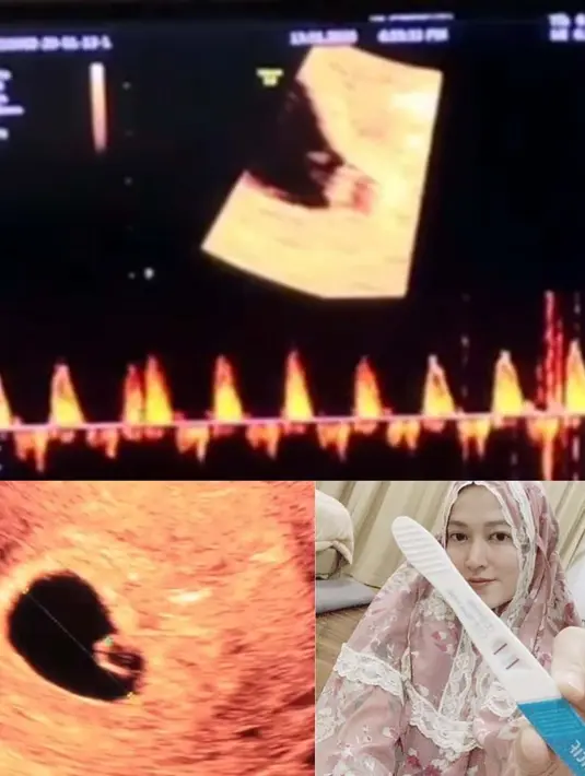 Lyra Virna (Instagram/fadlanmuhammad)