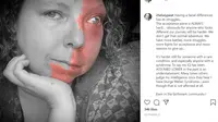 Cerita Chelsey, Wanita dengan Kelainan Neurologis dan Glaukoma di Wajah yang Bertemu Belahan Jiwa