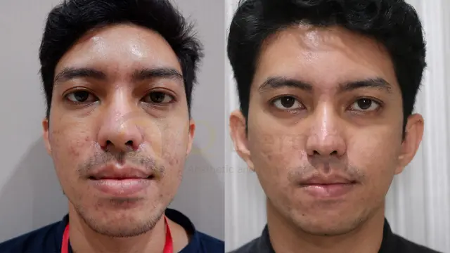 Perawatan Acne Scar