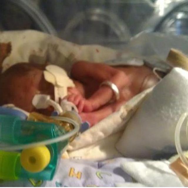 Bayi Lahir Prematur Berisiko Sesak Napas Saat Dewasa Health Liputan6 Com