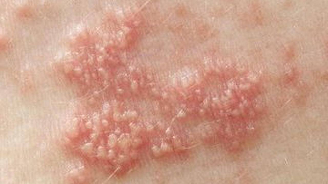 Cara Mencegah Herpes Zoster