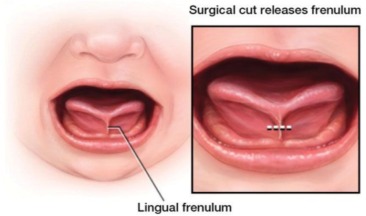 Ilustrasi Tongue Tie pada Anak