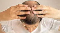 Kebotakan menjadi masalah rambut yang dapat terjadi pada siapa saja. Namun dengan sedikit trik gaya rambut, masalah ini dapat ditutupi. (Foto: iStockphoto)