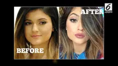 Perubahan wajah Kylie Jenner ramai dibicarakan warga net. Ternyata ada 6 operasi yang Kylie lakukan pada wajahnya. 