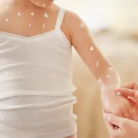 5 Cara Efektif Hilangkan Bekas Luka Cacar Air (Africa Studio/shutterstock)