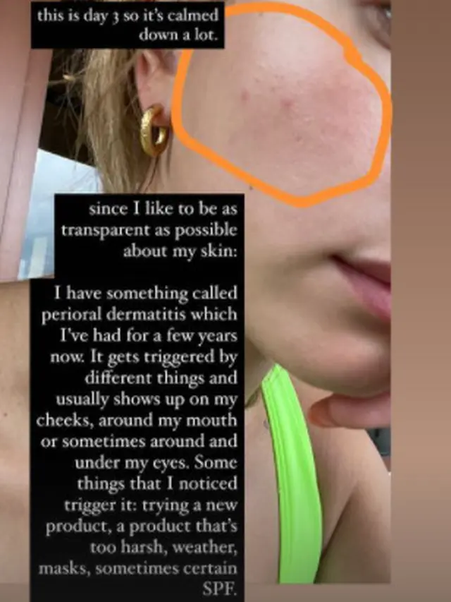 Menderita Dermatitis, Begini Cara Hailey Bieber Mengatasinya