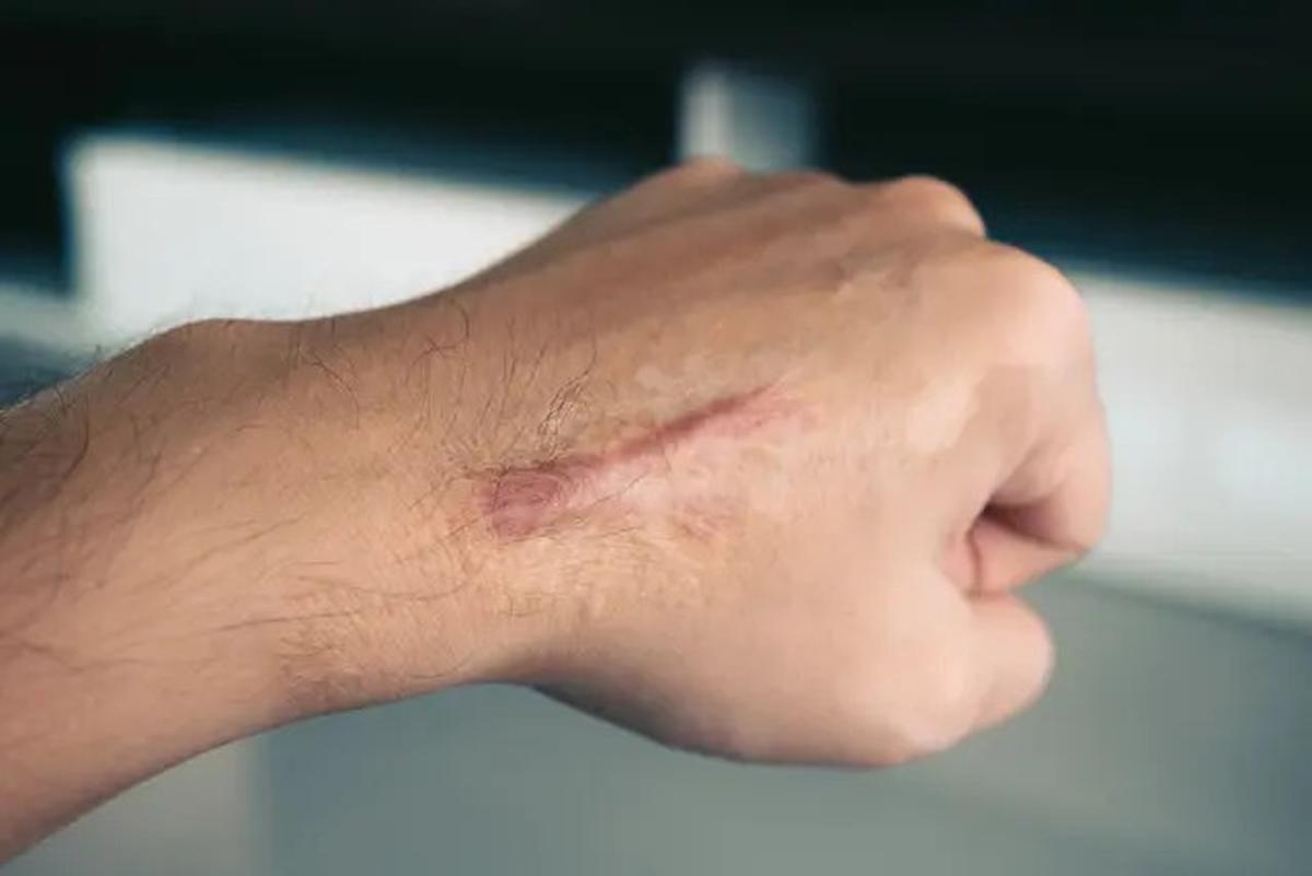 Mengungkap Keloid, Penyebab dan Cara Efektif Mencegahnya