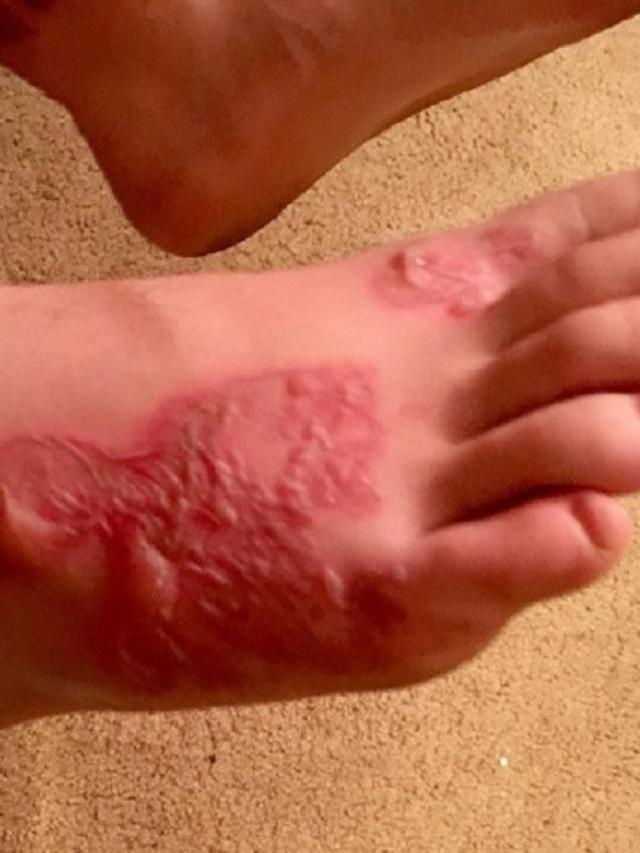 Masalah Kesehatan yang Ditandai dengan Kaki Gatal