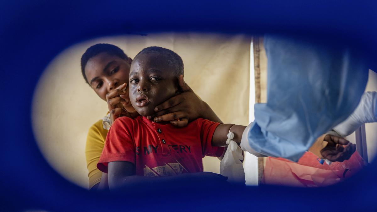 Kongo Akan Terima Vaksin Mpox yang Kini Jadi Darurat Kesehatan Global