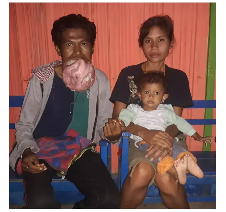 Yeskial Hun (30) warga Desa Huetalan Kecamatan Tobu Kabupaten Timor Tengah Selatan (TTS), menderita penyakit sejenis tumor dimulutnya.