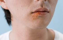 Herpes Genital Bisa Menyerang Siapa Saja, Begini Cara Mencegahnya