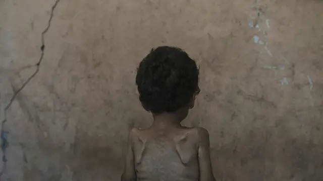 Yazan Abu Ful, balita usia dua tahun yang mengalami malnutrisi berada di Kamp Pengungsi Shati, Gaza, Rabu (23/7/2025).