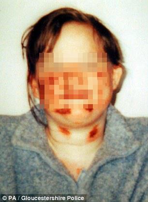 Victoria, wajahnya penuh luka dan memar karena kekejaman ibu angkatnya | Photo: Copyright dailymail.co.uk