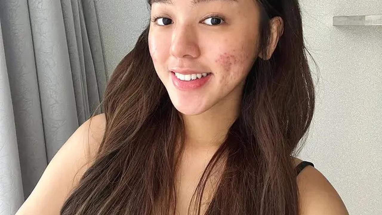 6 Potret Wajah Gabriella Ekaputri Berjerawat, Tetap Percaya Diri Tampil Natural