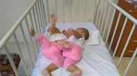 Potret Bayi Kembar Siam, Adam dan Malik yang akan menjalani operasi pemisahan. Saat ini kedua orangtua butuh dana untuk biaya operasi anak mereka (Reza Efendi/Liputan6.com)