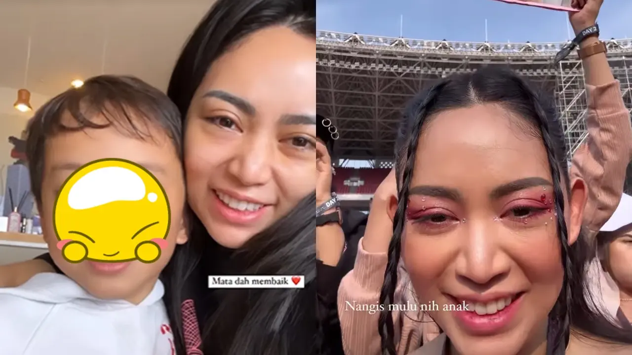 Rachel Vennya Operasi Plastik