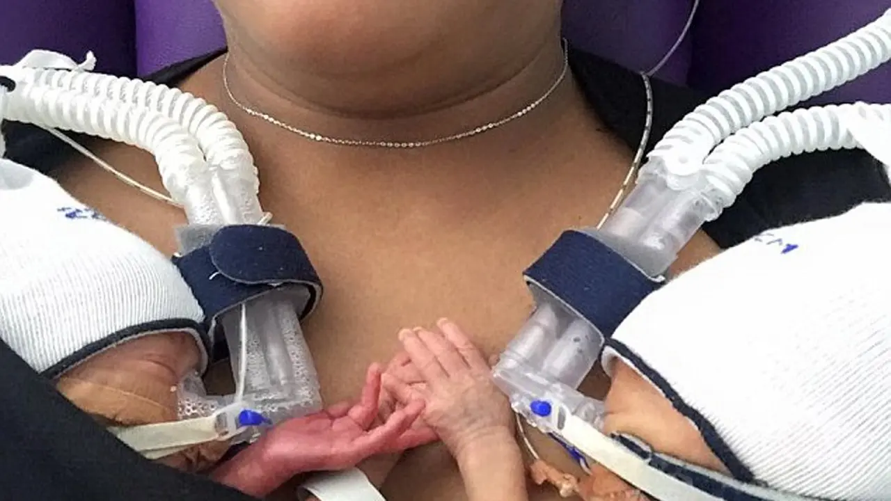 Lahir Prematur, Bayi Kembar Ini Selalu Berpegangan Tangan