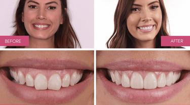 Bye Gummy Smile Makin Percaya Diri Dengan Senyum Cantik Tanpa Pamer Gusi Lifestyle Fimela Com