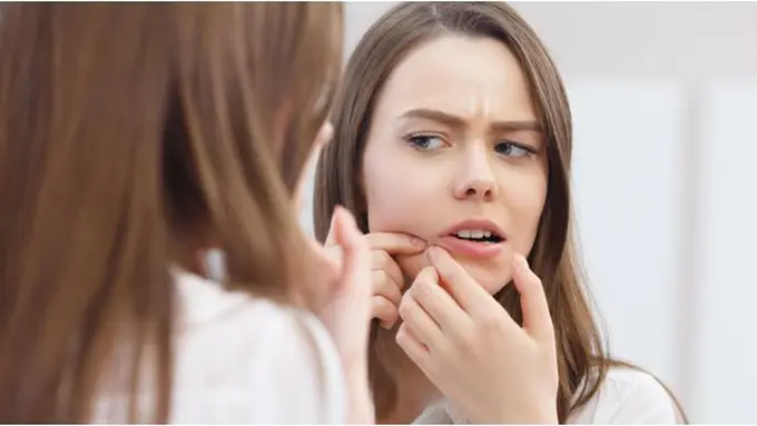 Penyebab jerawat/copyright Shutterstock.com