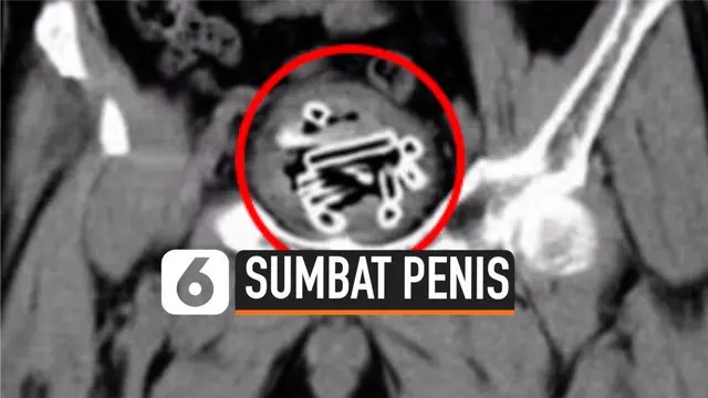 VIDEO: Pria ini Sumbat Penisnya dengan 47 Tabung Plastik
