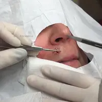 Menyaksikan rekaman pembedahan jerawat raksasa yang satu ini bikin kamu nggak mau makan!