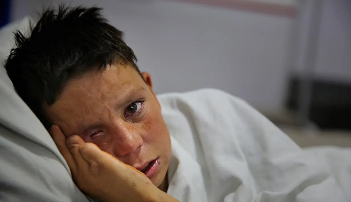 Farshid (13) menangis ketika berbaring di ranjang Pusat Bedah Darurat untuk Korban Perang Sipil di Kabul, Afghanistan, Kamis (12/12/201). Perang Afghanistan yang berlangsung selama empat dekade menimbulkan kerugian luar biasa di kalangan kaum muda. (AP Photo/Altaf Qadri)
