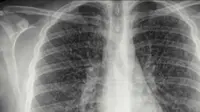 Foto organ dalam tubuh dengan menggunakan radiasi pengidap paru-paru popcorn. (sumber foto: CBS New York via Good Doctor)