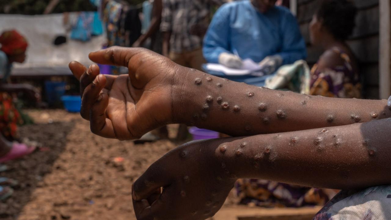 Antisipasi Mpox, Jokowi Minta Perketat Pengawasan Pintu Masuk Internasional Seperti Saat Covid