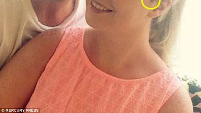 Mengerikan, Tahi Lalat Perempuan Ini Berubah Jadi Kanker Ganas