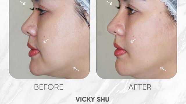 Perubahan wajah pada Vicky Shu