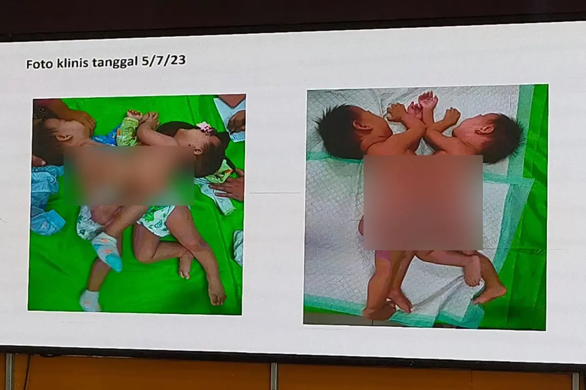 Bayi kembar siam ini akan dioperasi di RS Saiful Anwar Malang, Sabtu besok. (Istimewa)