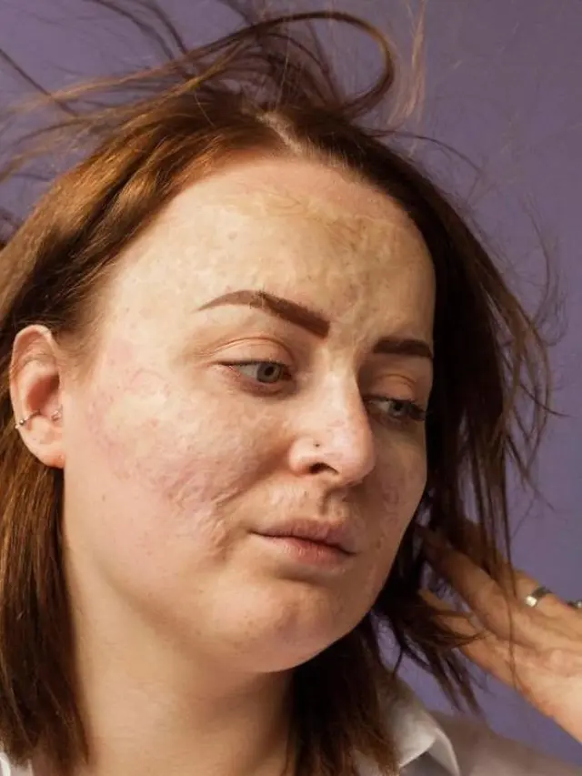 [Bintang] Cerita 5 Wanita dengan Bekas Luka di Tubuhnya, Bikin Terharu