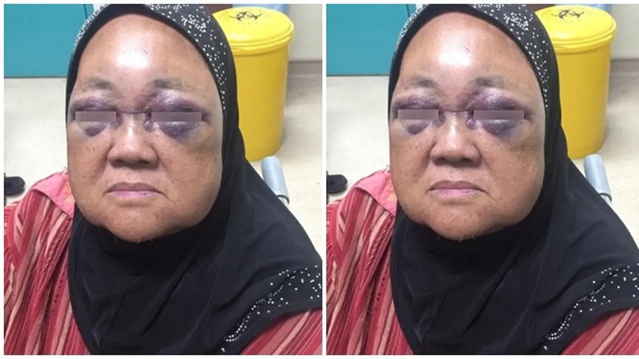 Nenek 69 Tahun Ini Hampir Buta Dipukul Oleh Cucunya, Alasannya Bikin Miris