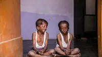 Ramesh (8) dan Laxman Jadhav (13) mengidap penyakit langka. Foto: The Sun.co.uk